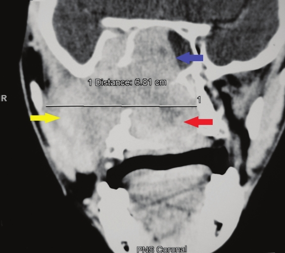 Coronal section, contrast-enhanced computed tomography scan shows a large heterodense destructive soft tissue lesion with intense contrast enhancement on the right maxillary antrum (yellow arrow), crossing the midline and displacing the nasal septum to the left (red arrow) and superiorly into the nasal cavity (blue arrow).